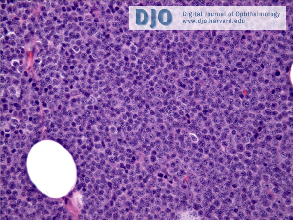 Lymph node biopsy of DLBCL showing sheets of large B-cells present. No follicular pattern observed (source)