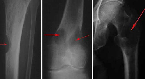 X-ray showing various lytic lesions typical of multiple myeloma (source)