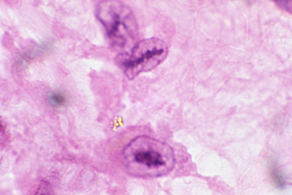 Anitschkow cells (source) 