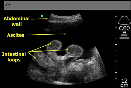 Ultrasound of ascites showing "swimming" intestines in the peritoneal fluid (source) 
