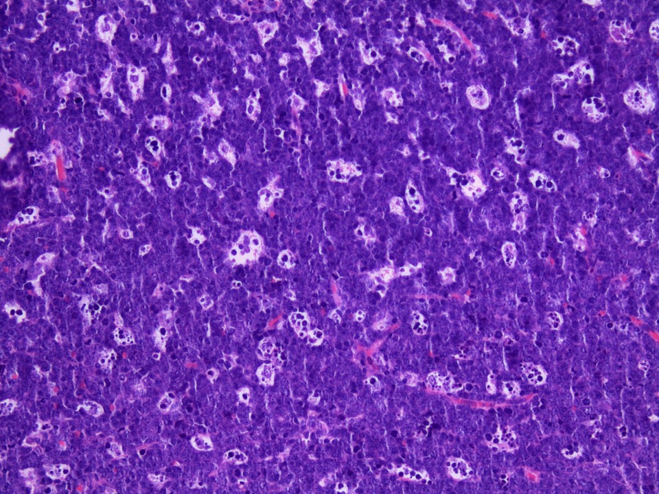 Classic "Starry sky" appearance of Burkitt's lymphoma (source)