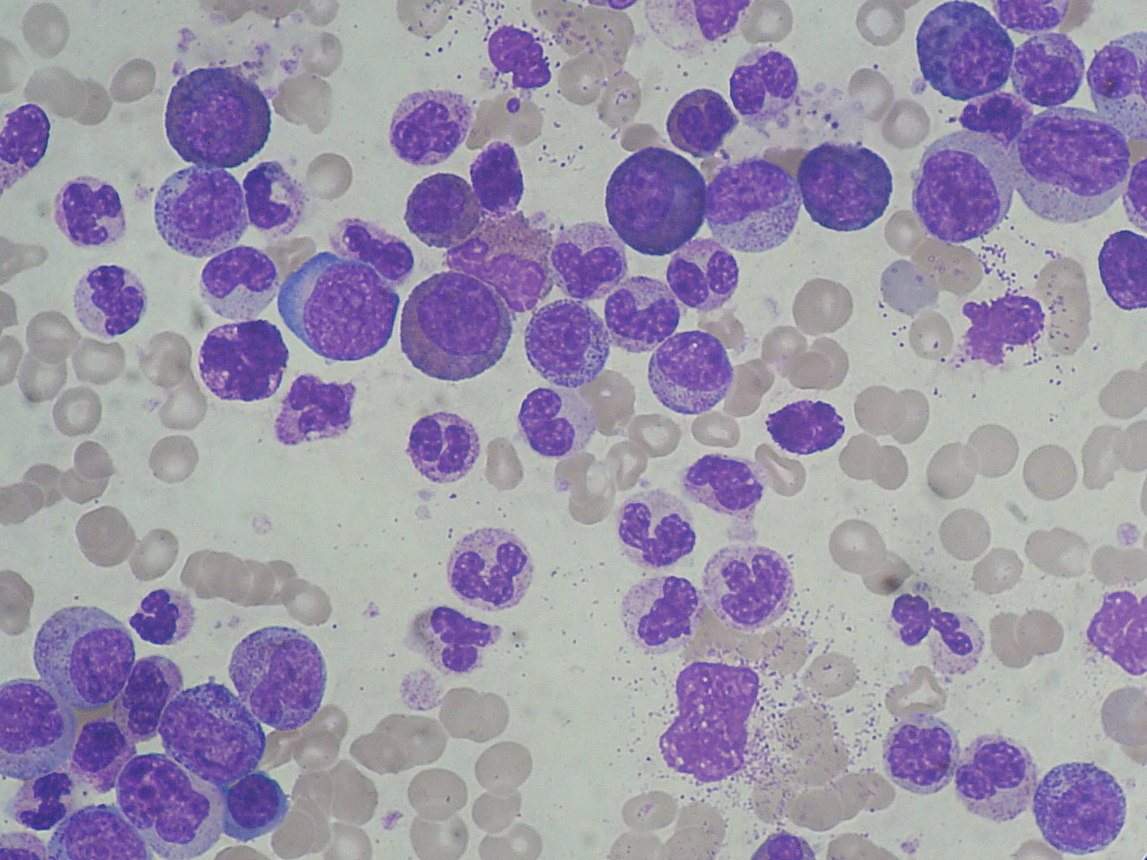 Blood smear from patient with CML showing increased granulocytes (source)
