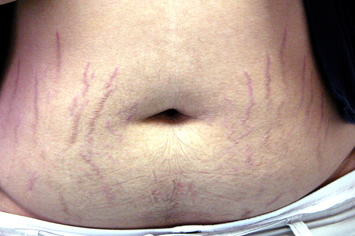 Striae and central obesity seen in a patient with Cushing syndrome (source)