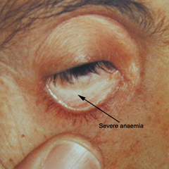 Conjunctival pallor seen in patient with severe anemia (source)