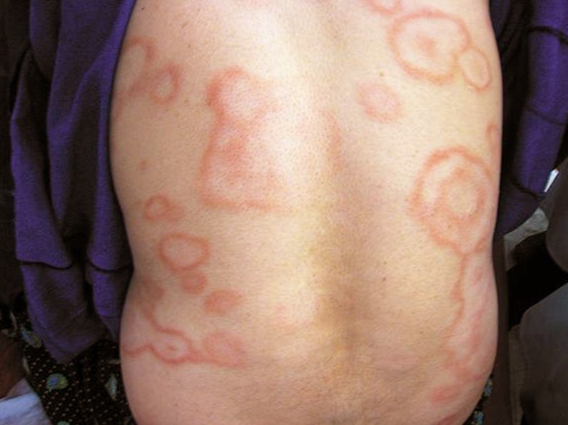 Clinical presentation of erythema marginatum (source)