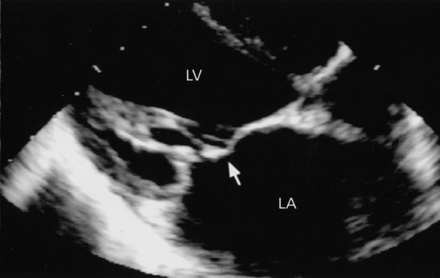 Echocardiogram showing severe mitral regurgitation and prolapse in a patient with rheumatic fever (source)