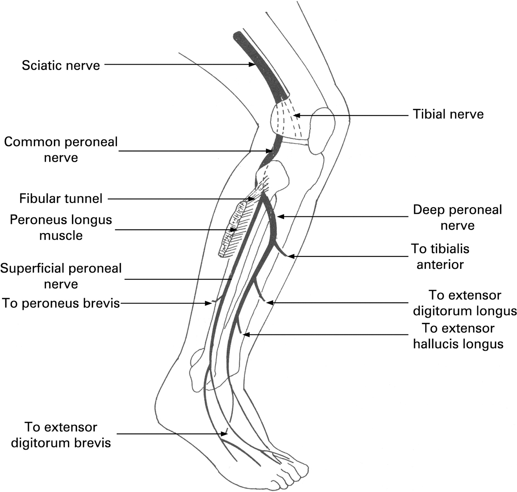 Common Peroneal Nerve Lesions