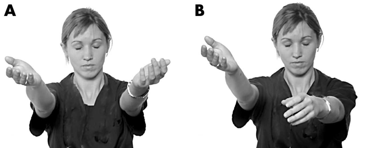 Patient with (B) and without (A) pronator drift (source)