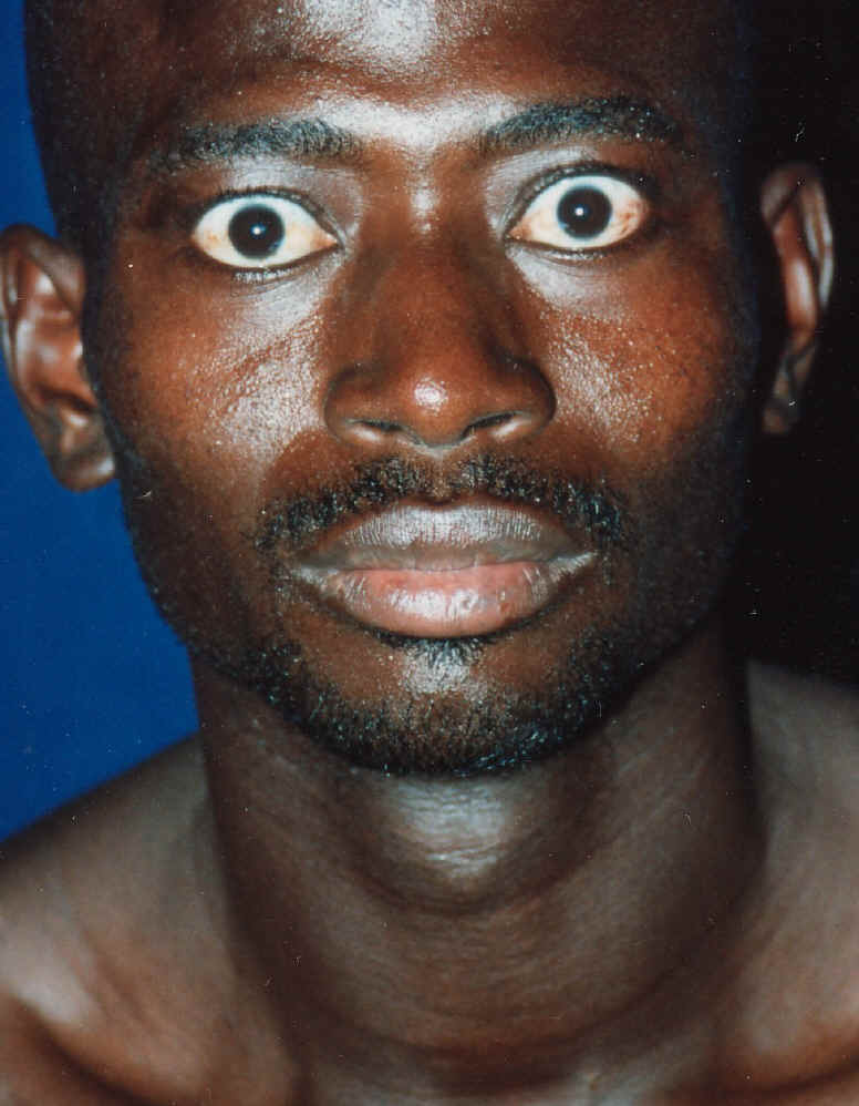 Goiter in a patient with Graves disease (source)