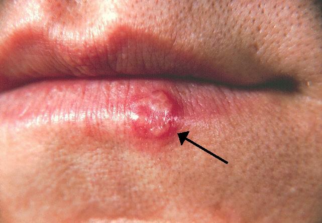 Outbreak of oral herpes/HSV1 (source)
