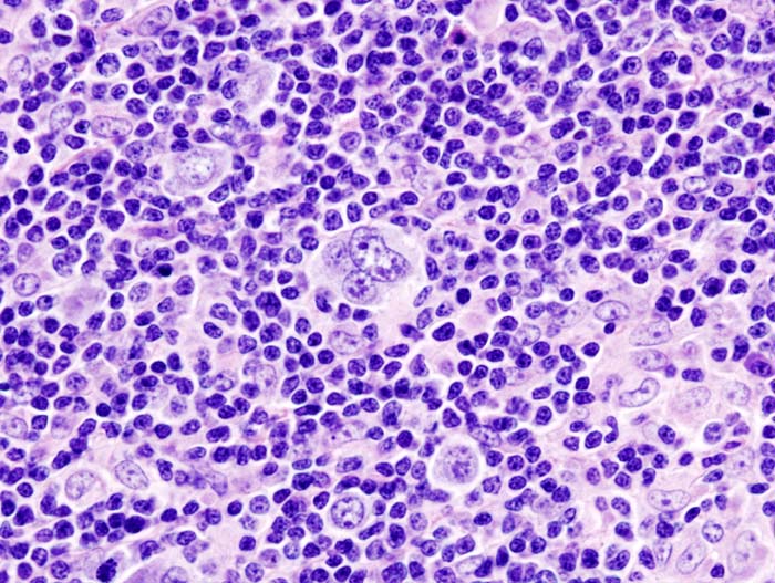 Biopsy of mixed cellularity HL (source)