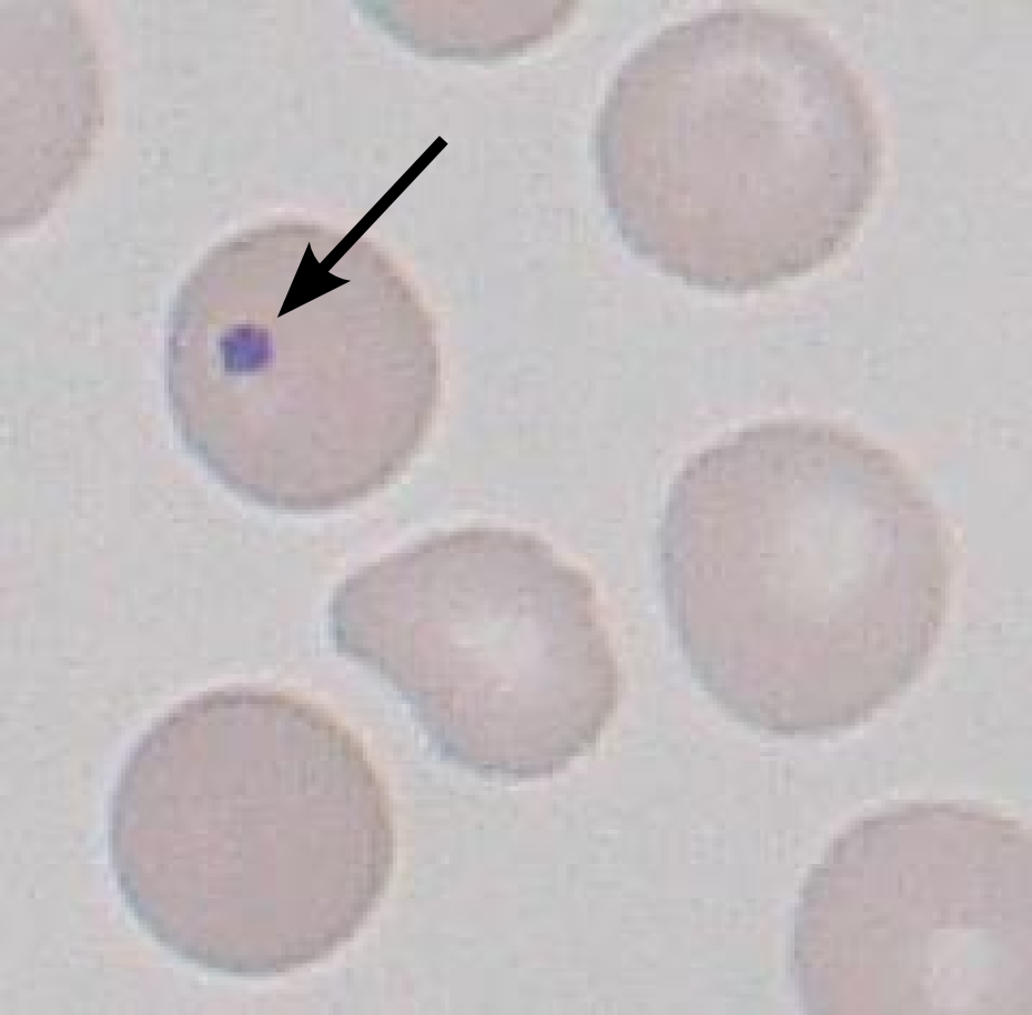Howell-Jolly body seen on a peripheral blood smear (source)