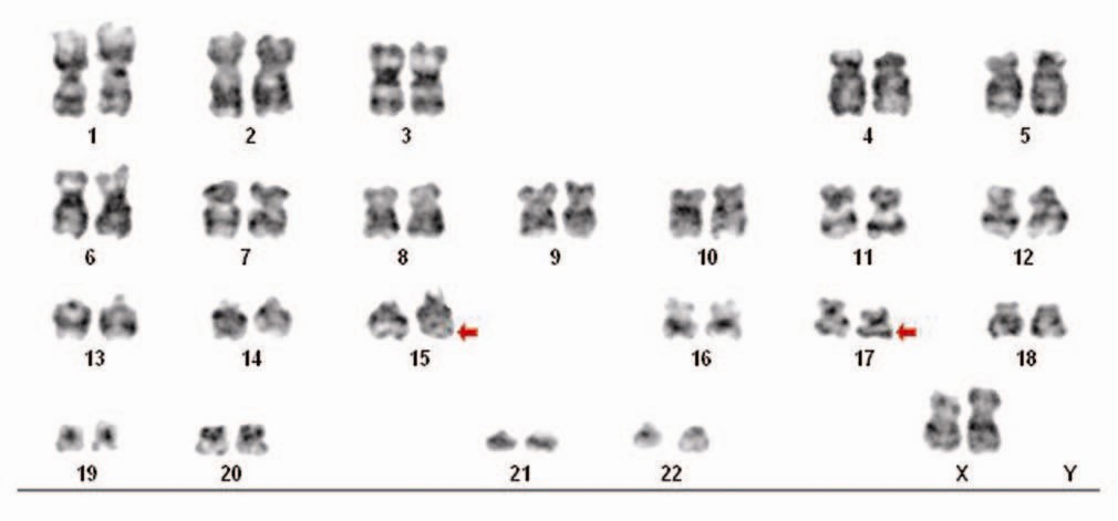 Visualization of translocation in acute promyelotic leukemia (source)