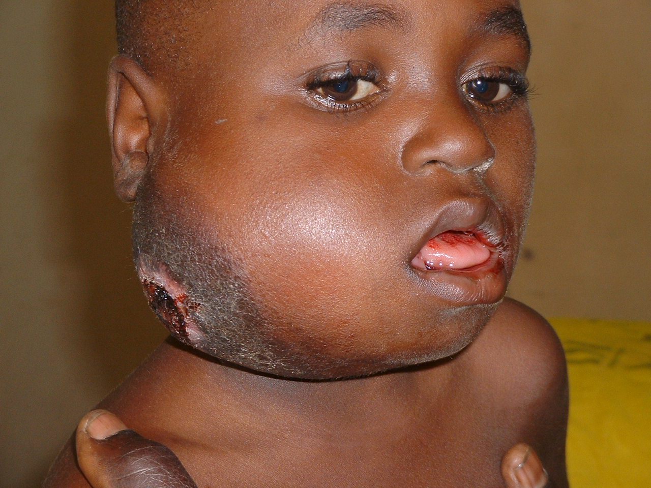 Clinical presentation of the African form of Burkitt's lymphoma (source)