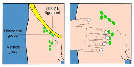 Location of inguinal lymph nodes (source)