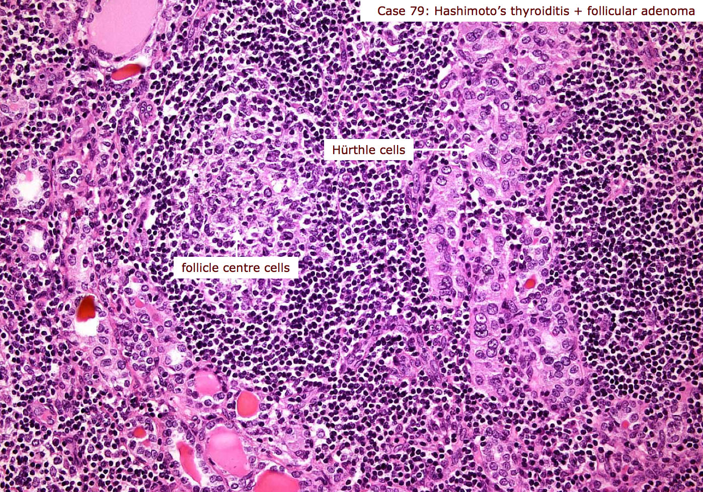 Biopsy demonstrating Hurtle cells in a patient that also has thyroid cancer (source)
