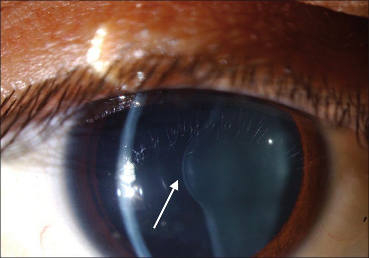 Anterior lenticonus in the right eye of a patient with Alport syndrome (source)