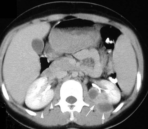 Perinephritic abscess seen on CT scan (source) 