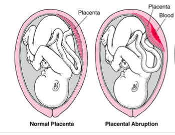 Comparison between a normal placenta, and placental abruption (source)
