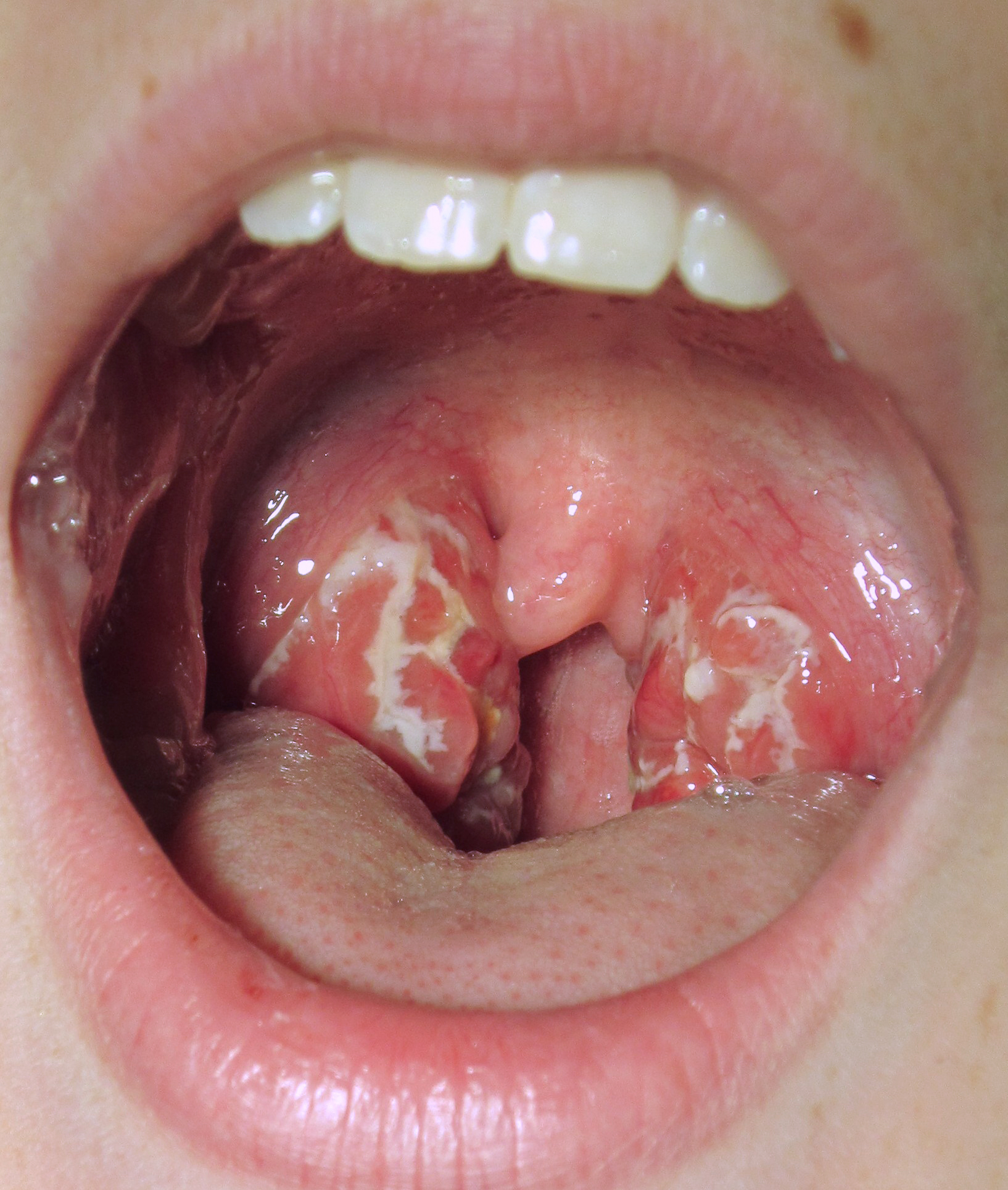 Exudative pharyngitis seen in a patient with a streptococcal infection (source)