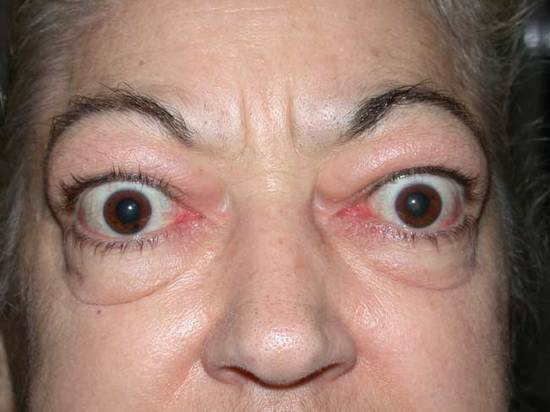 Protrusion of the eyes in a patient with Graves (source)