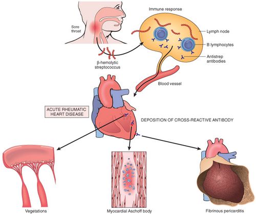 Pathophysiology of rheumatic fever (source)