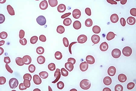 Crescent shaped RBCs and target cells (that look like a literal bull's eye) seen in a sickle cell patient's blood smear (source) 