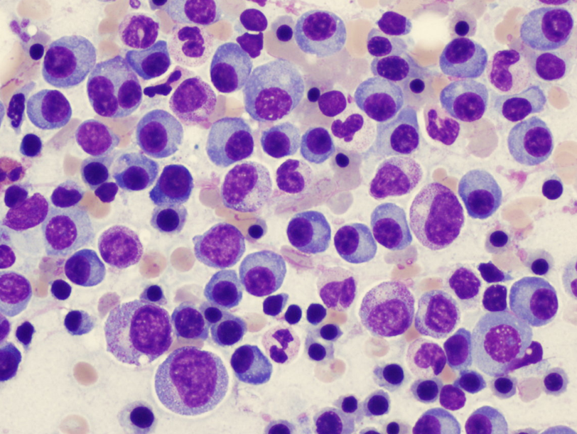 Typical "fried-egg" appearance of plasma cells in a blood smear of a patient with multiple myeloma (source)