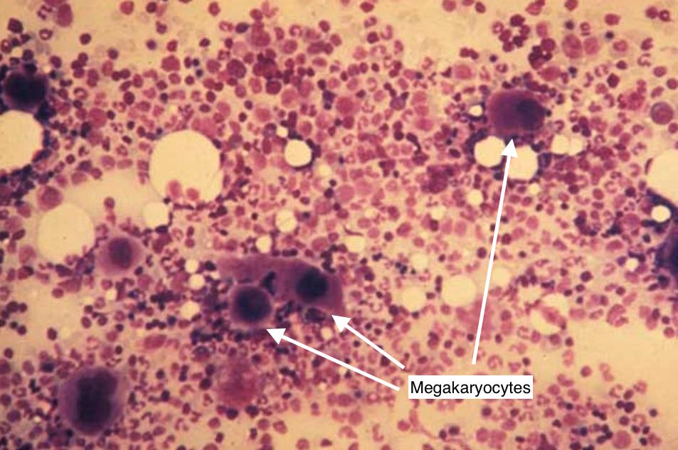 Increased megakaryocytes on an otherwise normal bone marrow biopsy of patient with ITP (source) 
