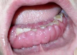 Swelling of the gums seen in patient with acute leukemia (source)