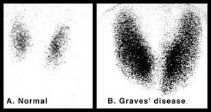 Diffuse increase in radio iodine uptake in patient with Graves compared to normal (source)
