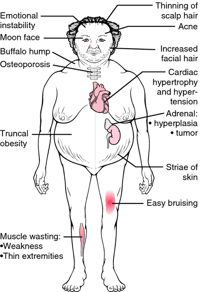 Various complications associated with Cushing syndrome (source)