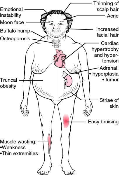 vores salon Bluebell Cushing Syndrome - Stepwards