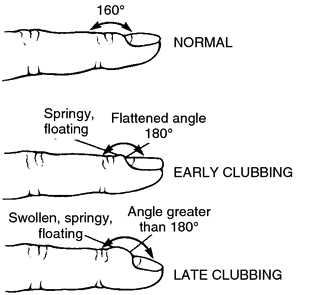 Progression of nail clubbing (source)