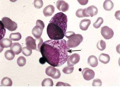 Auer rods seen in patient with AML (source)