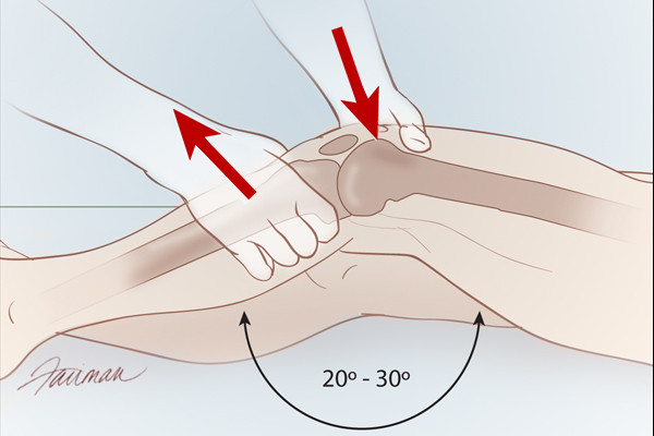 Lachman test procedure (source)
