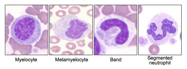 Various cell types that mark a "left shift" in a peripheral blood smear (source)