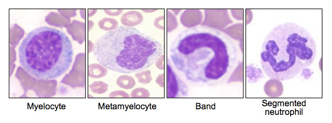 A Guide To Hematological Malignancies Cancers Stepwards