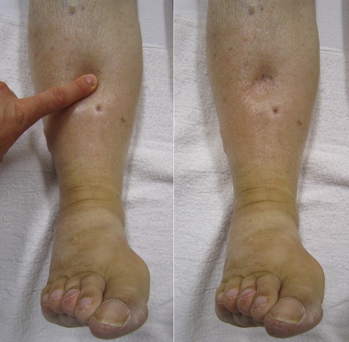Clinical example of pitting edema (source)