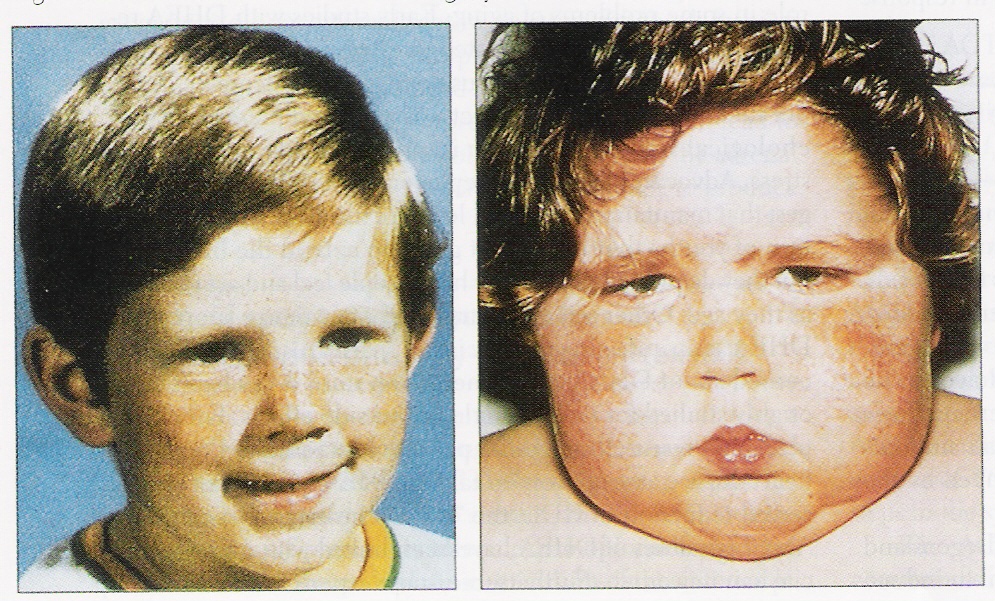 Round face (right panel) seen in patients with Cushing syndrome. Normal face seen on the left for comparison (source)
