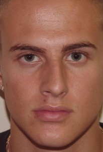 Patient with a deviated septum that is observable with external examination (source)