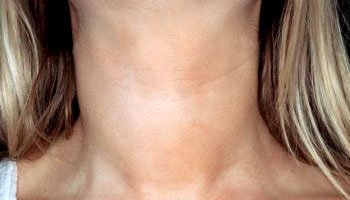 Goiter in patient with Hashimoto's thyroiditis (source)