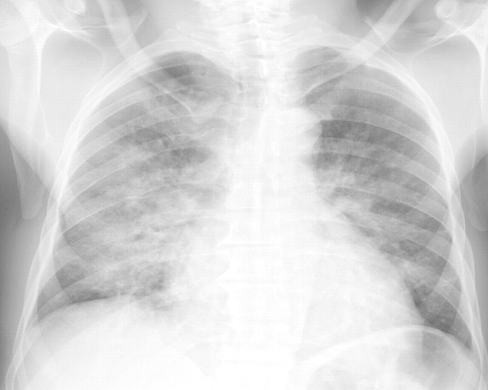 Chest X-ray of patient with acute chest syndrome (source)