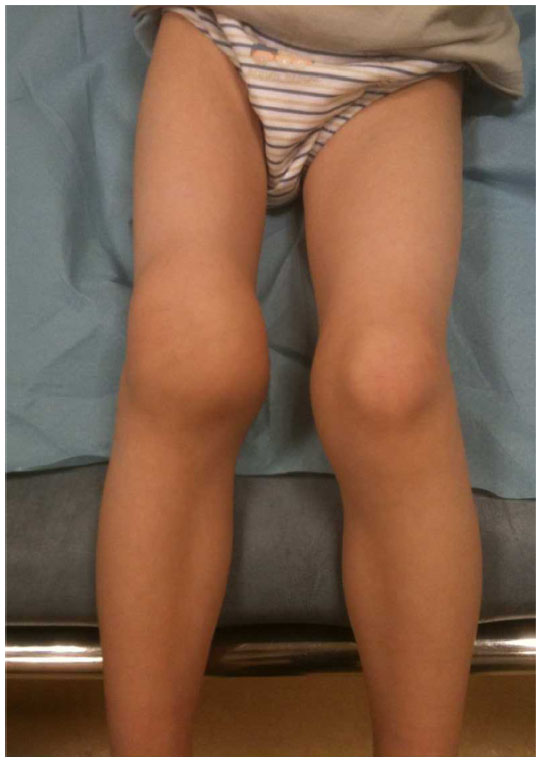 Acute hemarthroses in right knee of patient with severe hemophilia A (source)