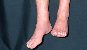 Clinical presentation of "foot drop" in a patient sitting on the side of an exam bed (source)