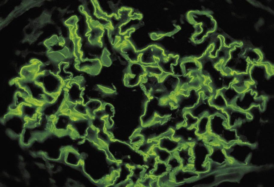 Immunofluorescence of kidney biopsy in Goodpasture syndrome. Note the linear pattern that marks the GBM (source)