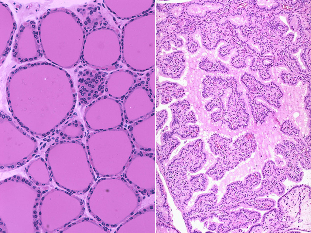 Comparison of normal thyroid biopsy vs. Graves (source)