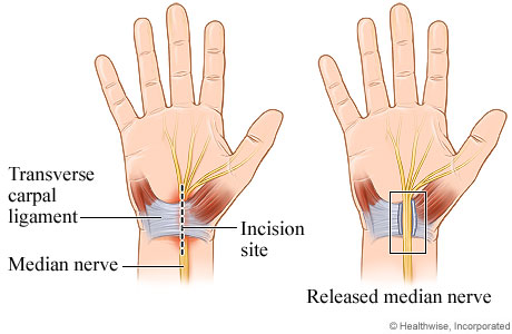 Carpal tunnel release surgery (source) 