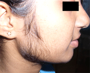 Hirsutism in a female patient (source)