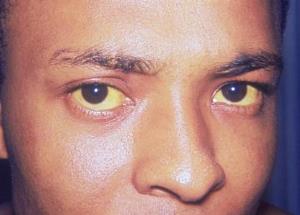 Jaundiced patient who presents with visibly yellow sclera of the eyes (source)